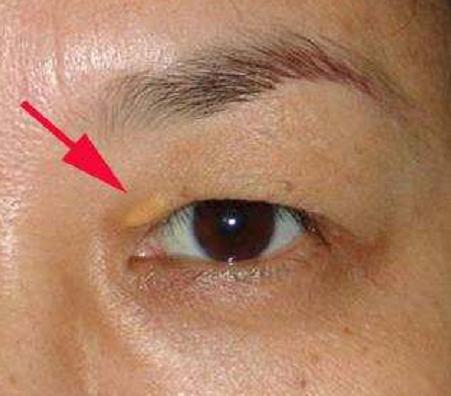 高血脂是"无声杀手",5征兆上身,就要及时降脂了|蛋白粉|胆固醇|雪豆