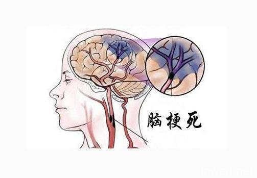 事实并非如此,近年来,突发脑梗的年轻人越来越多,脑梗的发生也是血管