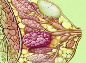 武汉一爹爹乳房有肿块没在意,拖了三年竟患上乳腺癌