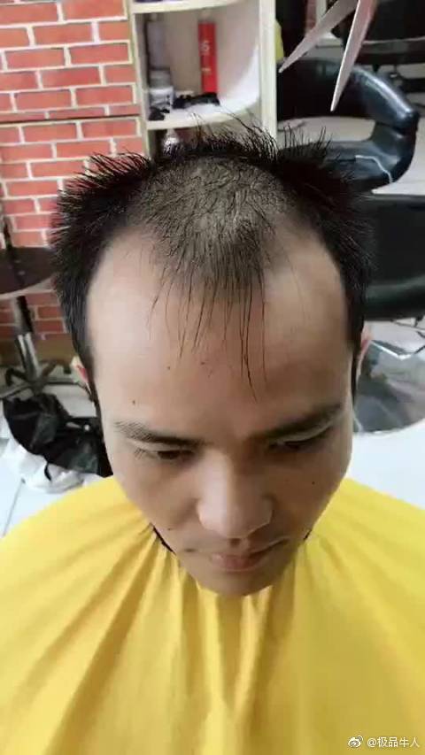 前额两边秃顶最适合的发型!转需.