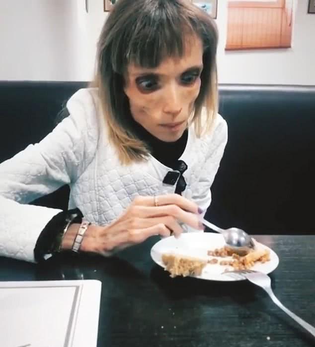 女子患厌食症体重只剩34斤,医生直言若不治疗1年内很可能死亡|Kristina|厌食症|体重_新浪新闻