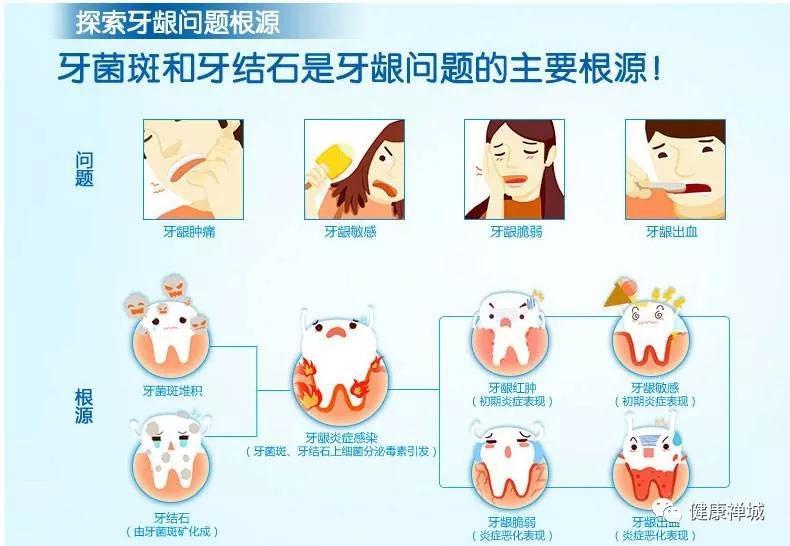 为什么牙医总建议你洗牙?