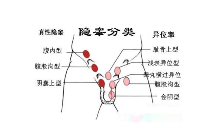 3岁男孩一睡觉,"蛋蛋"就不见了(图)|隐睾|睾丸|蛋蛋_新浪新闻