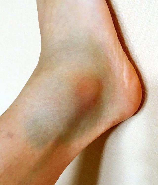 摔跤至脚踝淤青也不放弃训练奥运会结束后傅园慧的确参加了不少活动