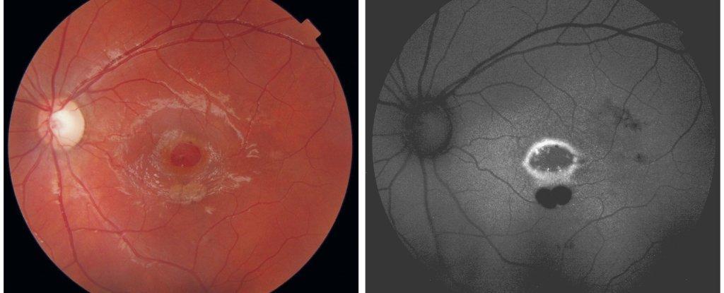 激光笔对于视网膜的损伤实际上非常常见.造成损害也并不需要很长时间.