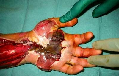 珍爱生命,远离毒蛇,毒蛇咬伤的图片