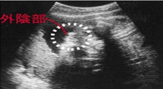 四维单子上有男女暗示 彩超怎么看男女其实有