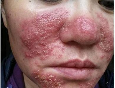 化妆品皮肤不良反应—化妆品接触性皮炎