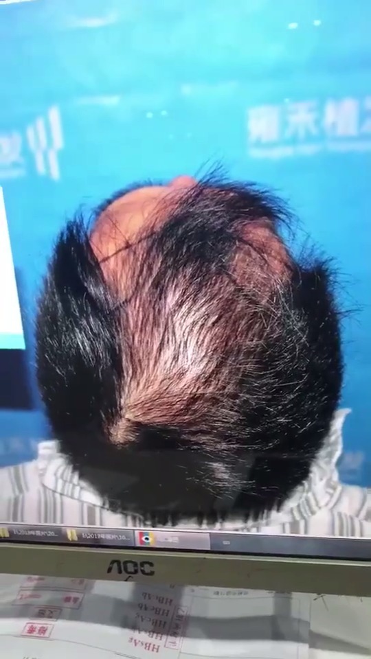 脱发掉发严重一定要引起警惕