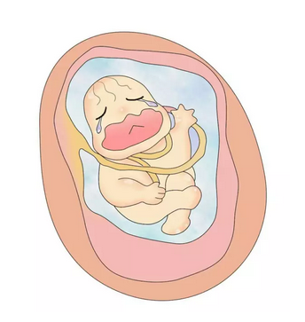 宝宝脐带绕颈了,多半和这5个因素有关,孕妈妈别大意