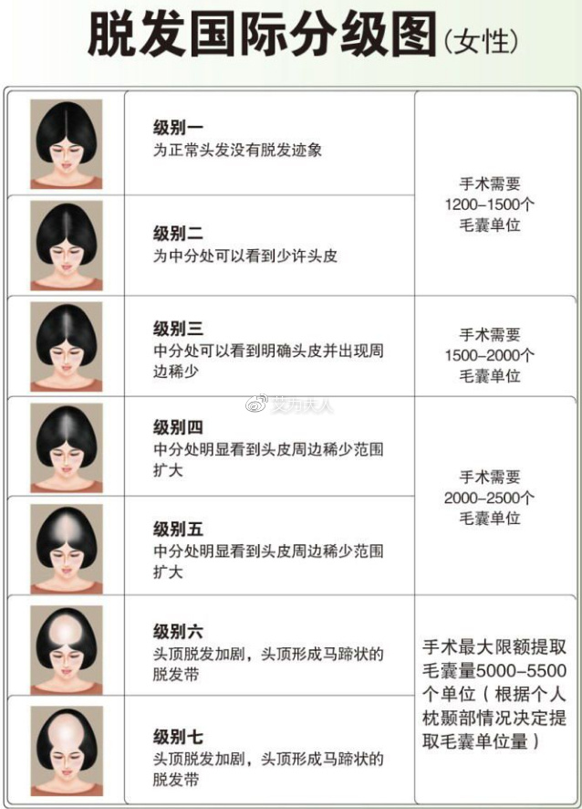 两张图教你区分脱发等级