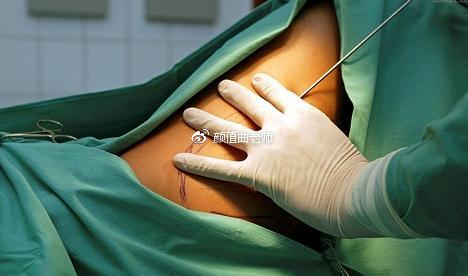 抽脂手术几乎是满意度最高的一项整形手术.