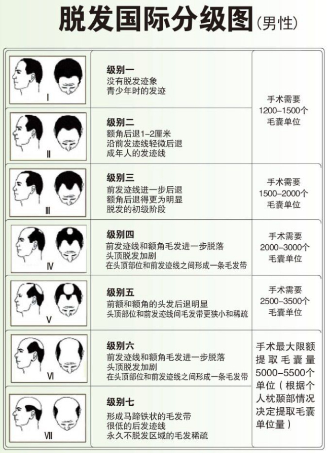 两张图教你区分脱发等级