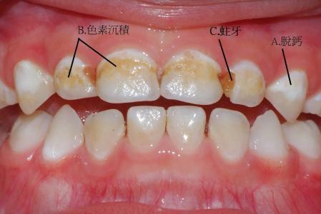 龋齿给宝宝带来这3大坏处,想牙齿健康,一定要掌握正确刷牙方法