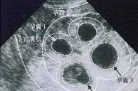 十九岁少女怀孕五个月肚子却如此大!医生检查结果,丈夫泪目