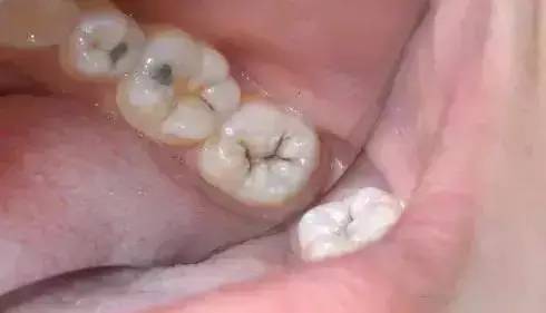 龋齿不痛可以不补吗?什么才是正确处理龋齿的做法?