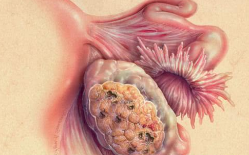 然而,坏消息是,目前我们还不太清楚卵巢恶性肿瘤的病因,除了遗传性