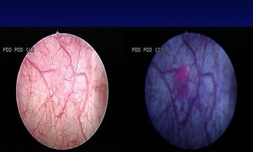 肉眼血尿一种会痛 一种不会痛 它和膀胱癌大有关系!