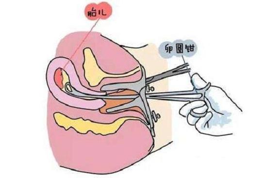 一,流产手术的分类主要有钳刮术(如上图),吸刮术及药物流产.