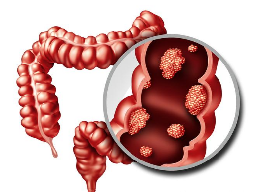 结直肠癌确诊,躲不开这两个检查,需要的人来了解一下