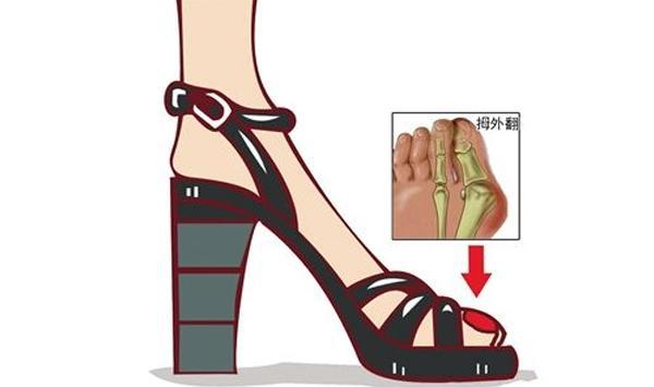性别外,最重要的是穿鞋习惯,尤其穿高跟鞋时,因足部受力点集中于脚掌