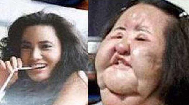 整形失败的女人, 脸部严重毁容, 看完这些你还敢去整容吗