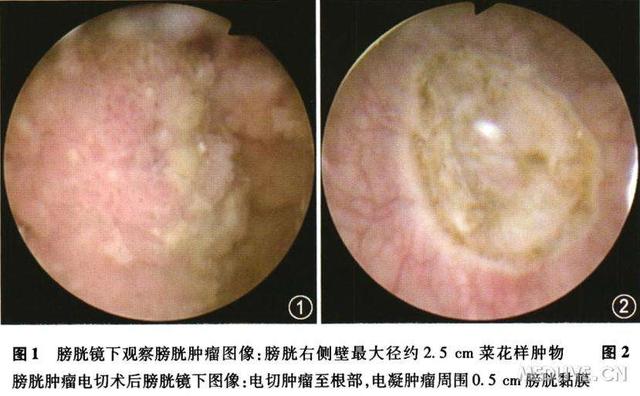 肉眼血尿一种会痛 一种不会痛 它和膀胱癌大有关系!