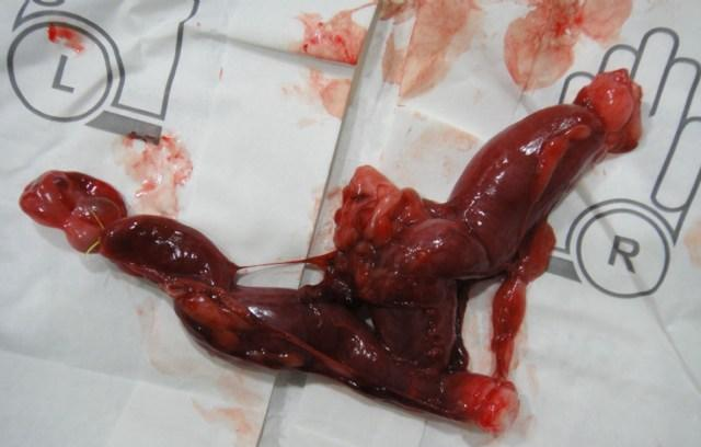 产妇生下男婴30天后,上厕所竟掉出"一块肉",医生当场怒斥无知