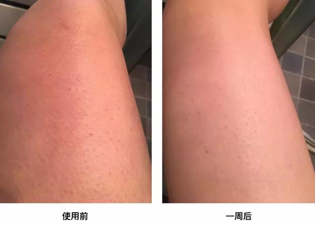 怎么去除鸡皮肤让皮肤光滑(怎么去除鸡皮肤让皮肤光滑一点) 怎么去除鸡皮肤让皮肤光滑(怎么去除鸡皮肤让皮肤光滑一点)