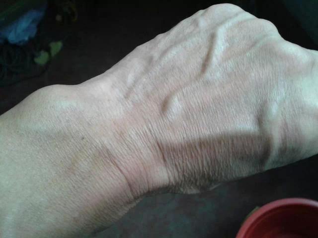 别乱猜,这次告诉你真正答案|青筋|手背|静脉曲张_新浪新闻