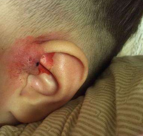 小孩外耳廓发炎图片图片