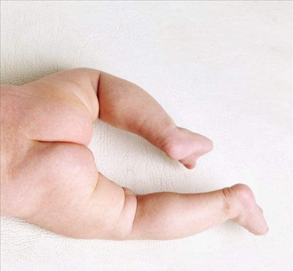 宝宝臀部一边大变小,这是正常的,婆婆说,但医生却查出严重问题
