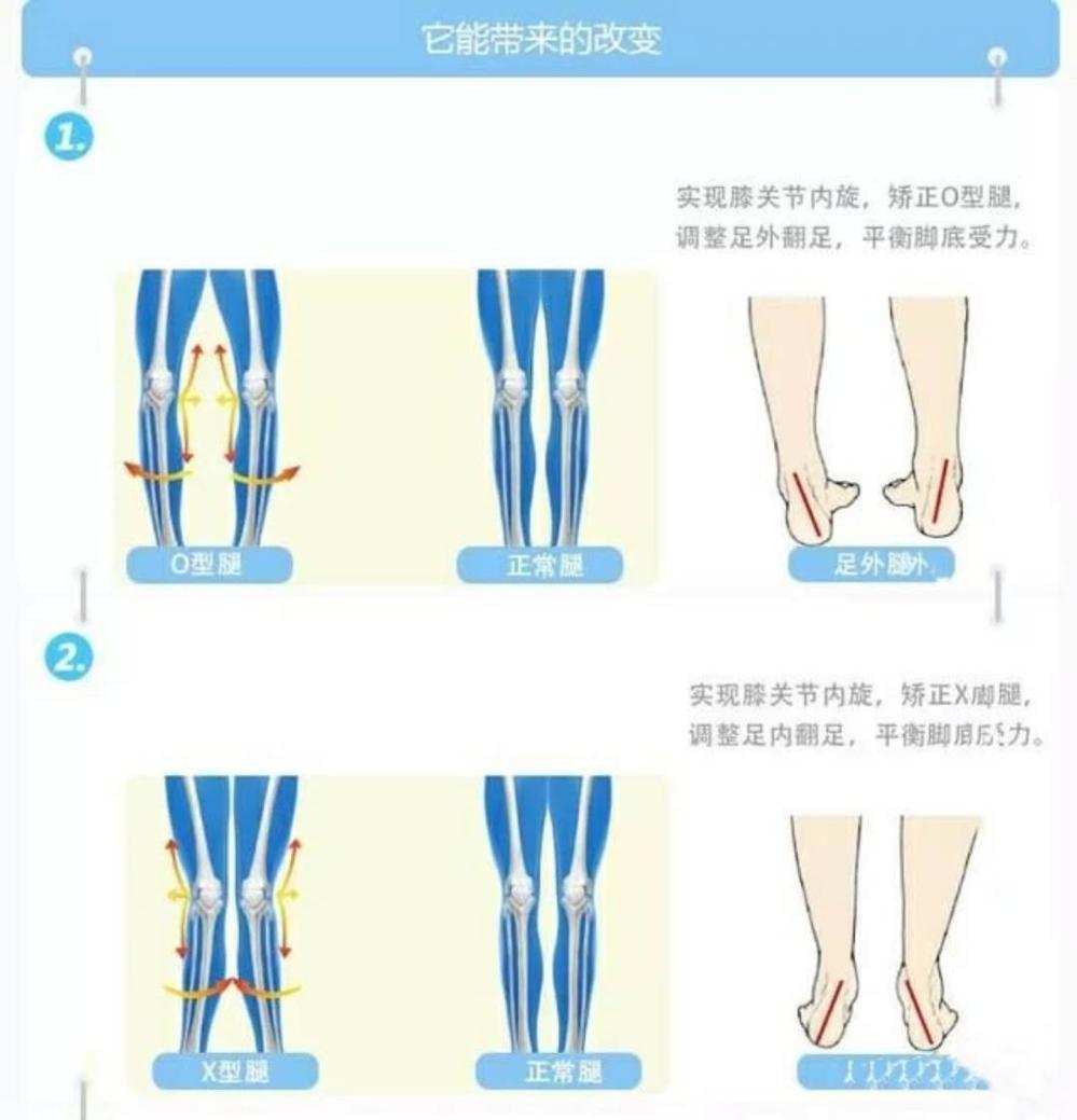 一些人的腿是直的而另一些人却是弯的是什么原因导致的
