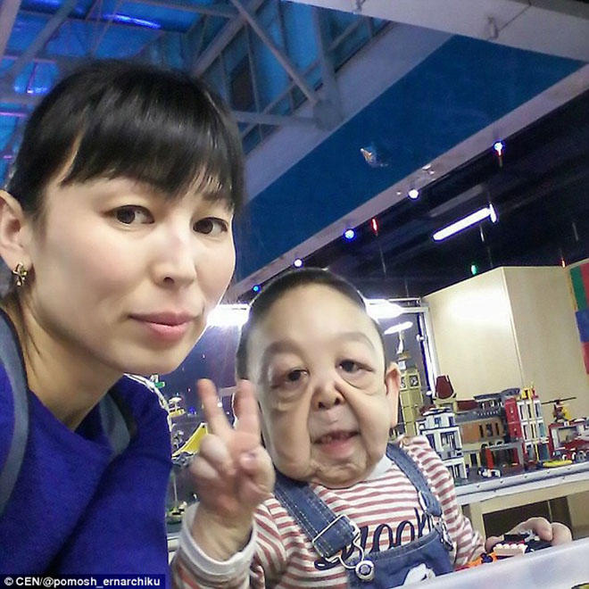6岁男童得罕见疾病急速衰老,皮肤松弛已如百岁老人