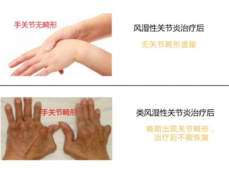 风湿性关节炎和类风湿性关节炎居然是两种病?区别还这么大