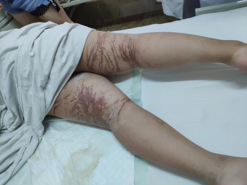 8岁男孩被海蜇蜇伤,情况严重,瓦房店人下海一定要注意了