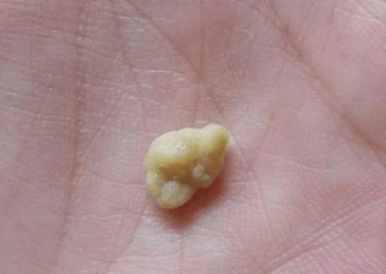 25岁女孩常年口臭不能谈男友原来是喉咙里的小米粒惹的祸