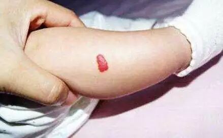 新生儿身上长小草莓,婆婆说胎记不用担心,医生的话让宝妈不淡定