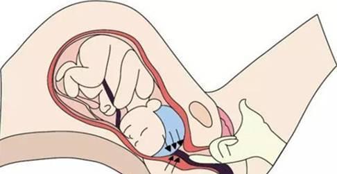 每次间隔5,6分钟,然后会越来越频繁和剧烈,直到宫颈口逐渐打开,对初