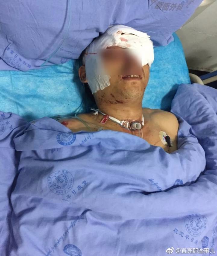 宜宾男子脸被熊咬烂后3女1儿哭诉抢救8小时依然病危