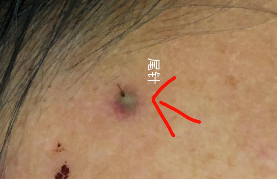蜜蜂,黄蜂,马蜂的尾针刺入皮肤时,会将大量毒液带入人体,尾针经常残留