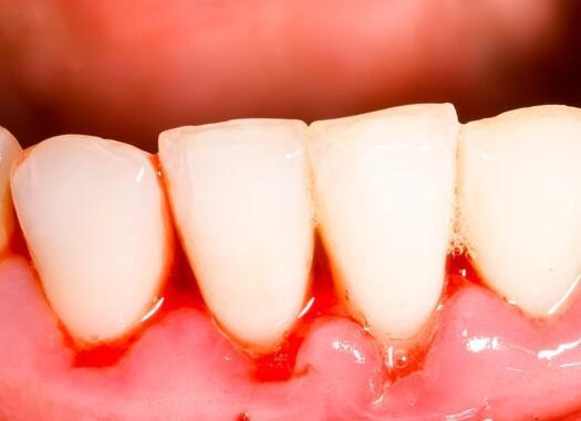 刷牙时总是牙龈出血? 它的出现主要跟这几点脱不了干系!|牙龈出血|刷