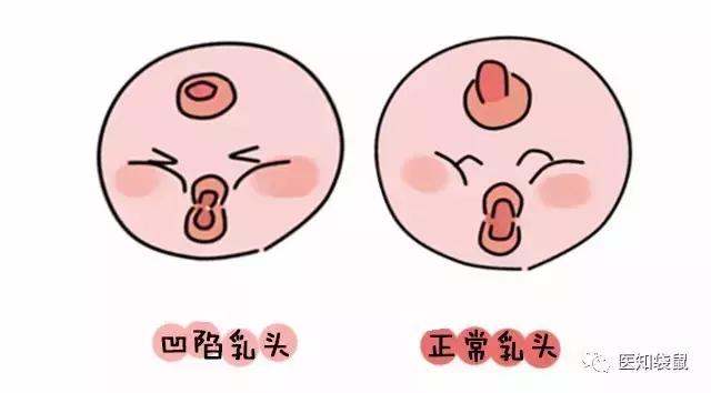 母乳喂养不容易!乳头皲裂,乳腺炎,这些疼痛谁没经历过?