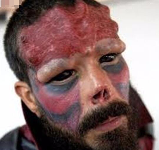 2个孩子的父亲着迷动漫人物,竟切掉半个鼻子整成骷髅