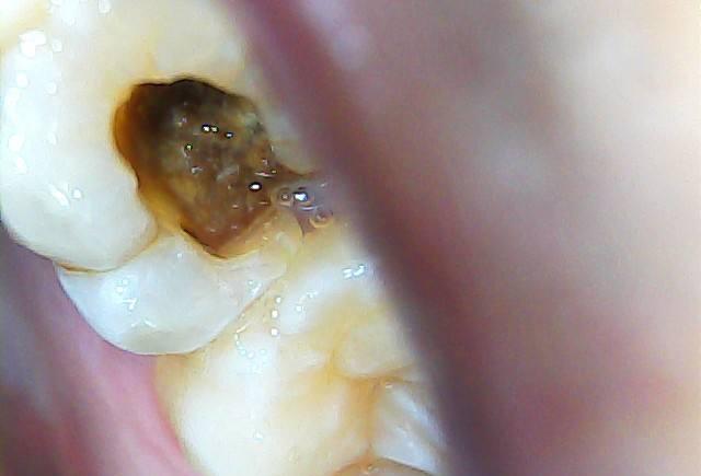 每天都刷牙,比骨头还坚硬的牙齿为什么照样龋坏?