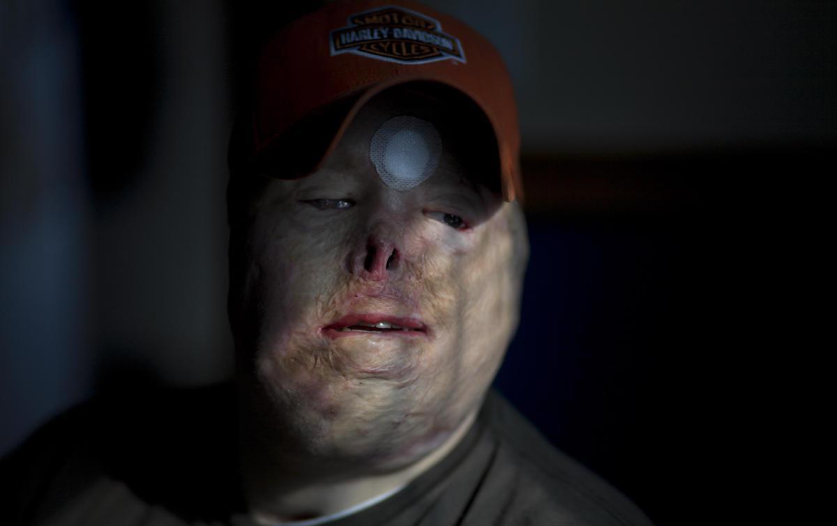 士兵在战场上炸烂了脸后, 女朋友照常嫁给了他但没看到笑