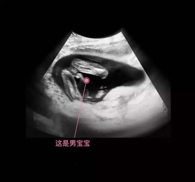 男孩孕囊图片