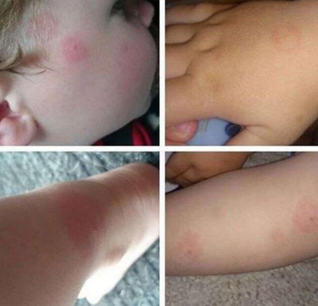 宝妈警惕,宝宝身上出现这种红色印记,应立即去医院,别耽误孩子
