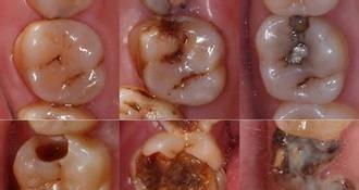 传说中的虫牙, 难道你的牙齿里真的有虫子?__财经头条