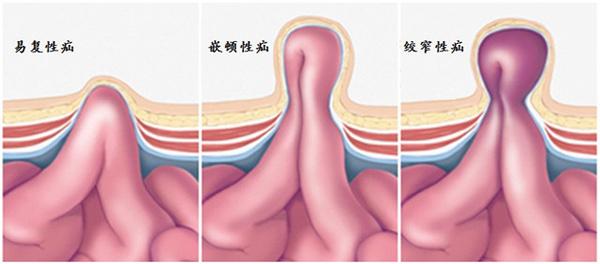 男子疝气拖6年,小肠坏死10公分